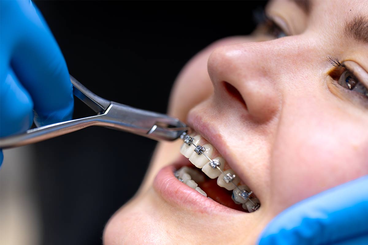 ارتودنسی مجدد و راهکارهای بهبود طرح لبخند 