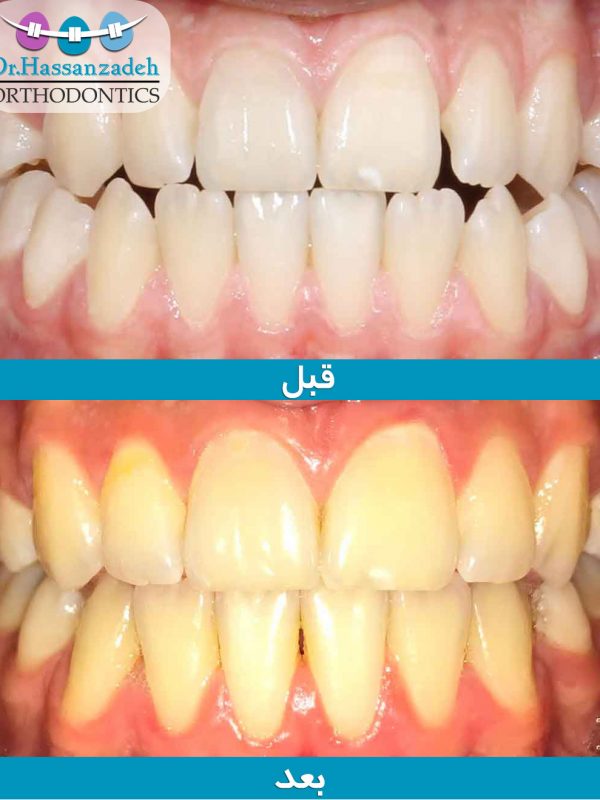 قبل و بعد از درمان اورتودنسی