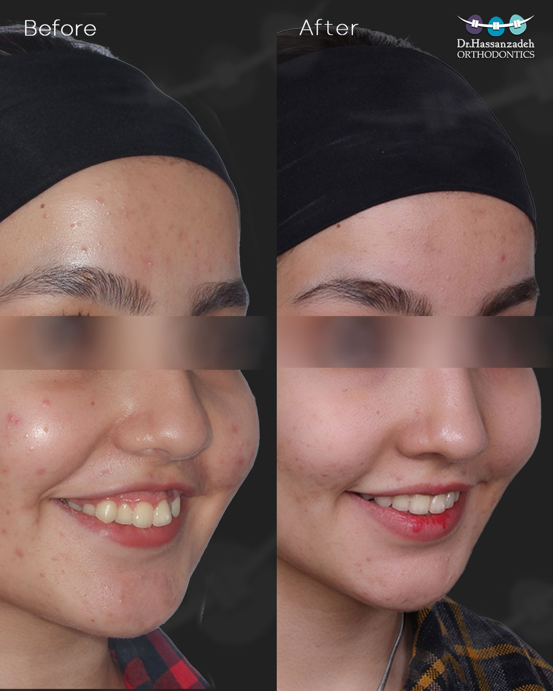 قبل و بعد از درمان اورتودنسی