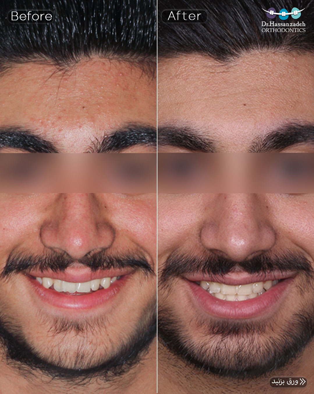 قبل و بعد از درمان