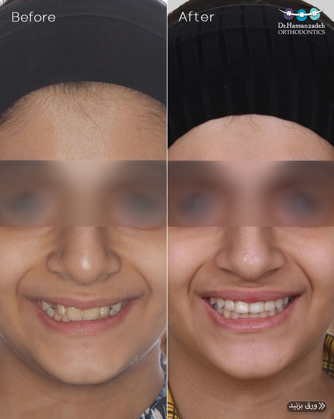 قبل و بعد از درمان