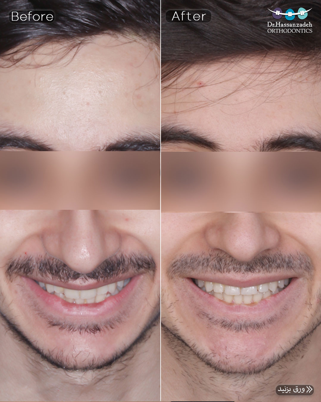 قبل و بعد از درمان