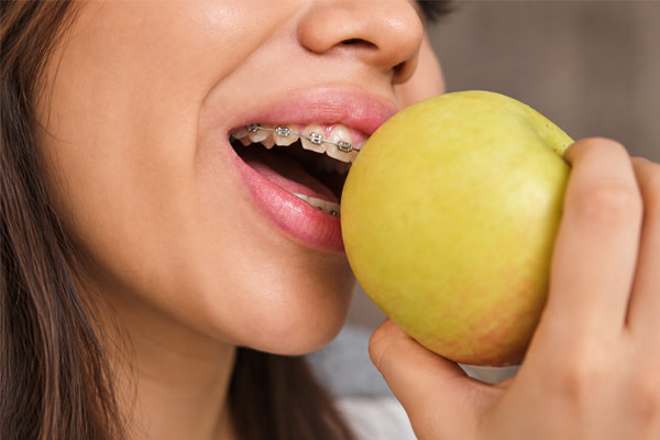 ۱۰ اشتباه رایج بعد از ارتودنسی؛ چه کارهایی نباید انجام دهیم؟