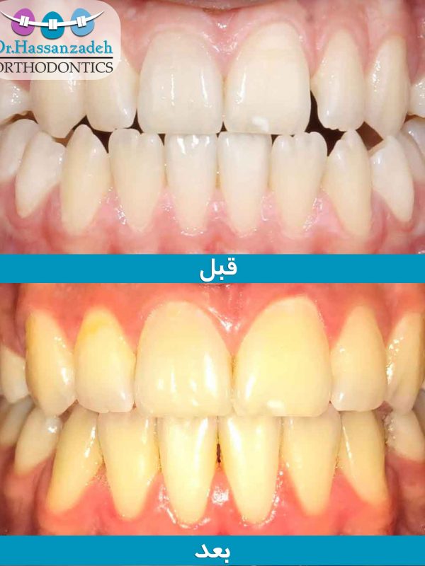 قبل و بعد از درمان اورتودنسی